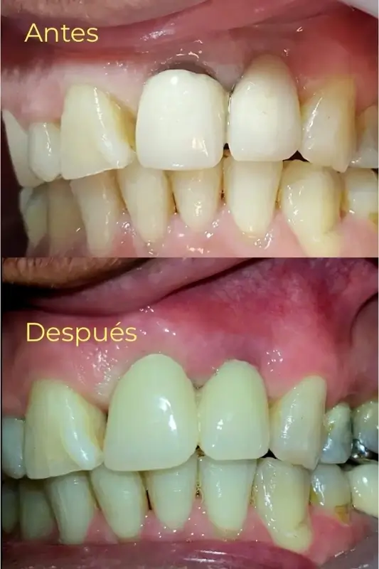 5 Casos de Exito - Armonía Dentofacial - Servicios